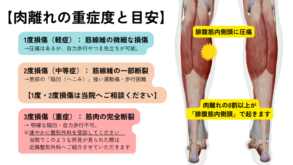 日野駅前やまぐち鍼治療院が解説する肉離れ重症度。
肉離れの8割は「腓腹筋内側頭」で起きる。1度損傷・2度損傷・3度損傷。整形外科受診の目安。